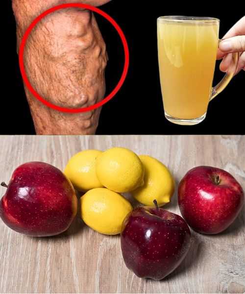 I AM SHOCKED! Dissolve Blood Clots and Boost Circulation with Apple and Lemon Juice!