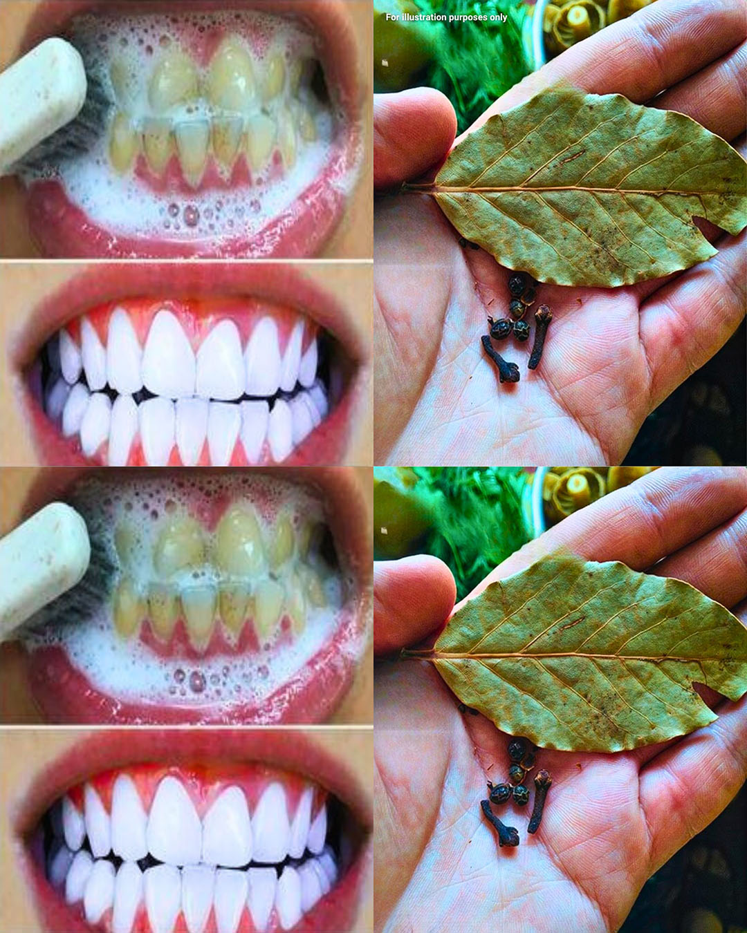 How to Whiten Your Teeth with Cloves and Bay Leaves