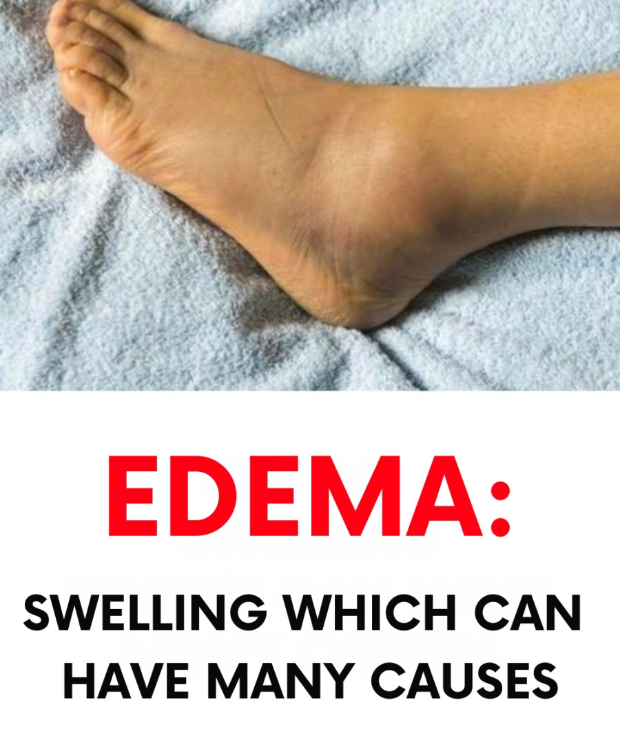 Edema: a swelling that can have many causes