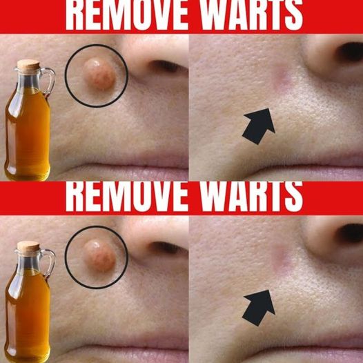 The Natural Wonder: Apple Cider Vinegar for Wart Removal