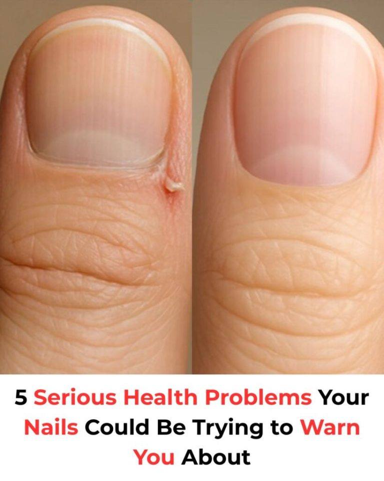 5 Serious Health Problems Your Nails Could Be Trying to Warn You About