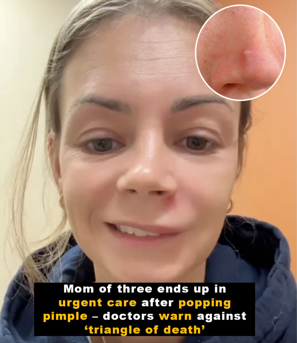 Doctors warn of popping pimple in ‘triangle of death’