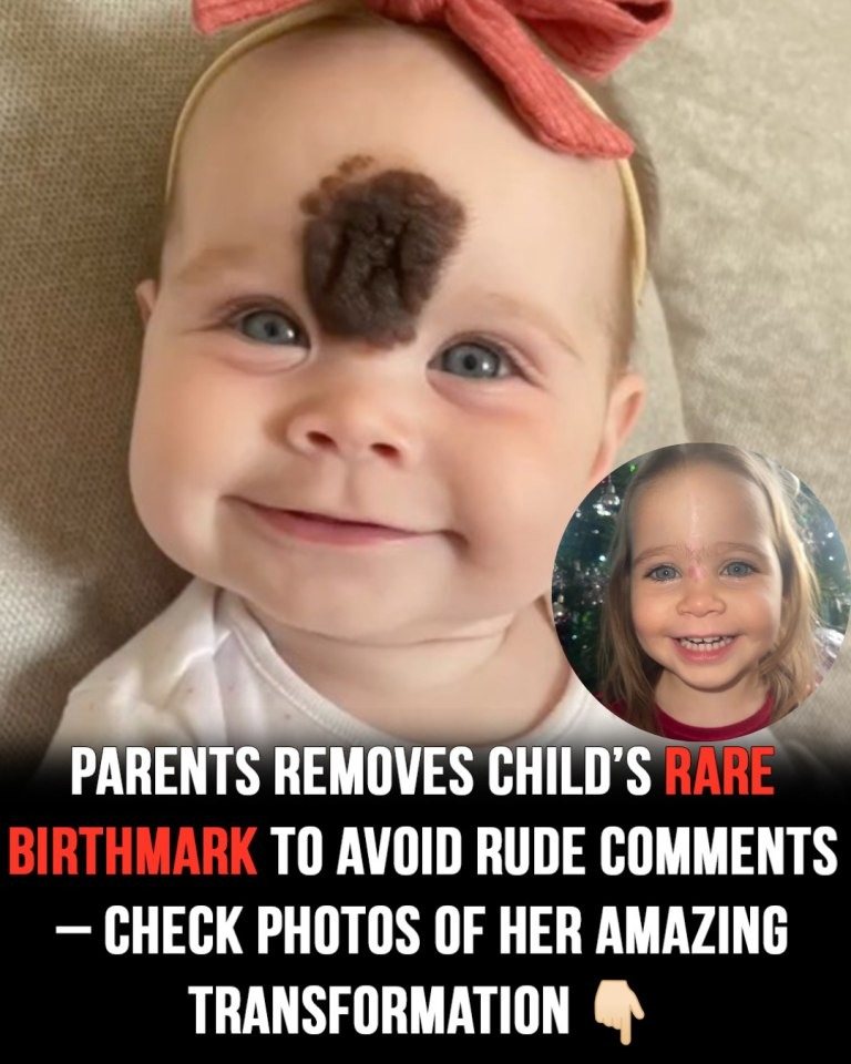 Cruel reactions force parents to remove baby’s rare birthmark