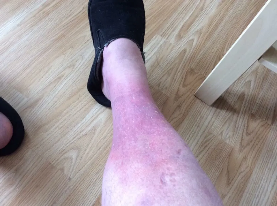 Curing Cellulitis Permanently