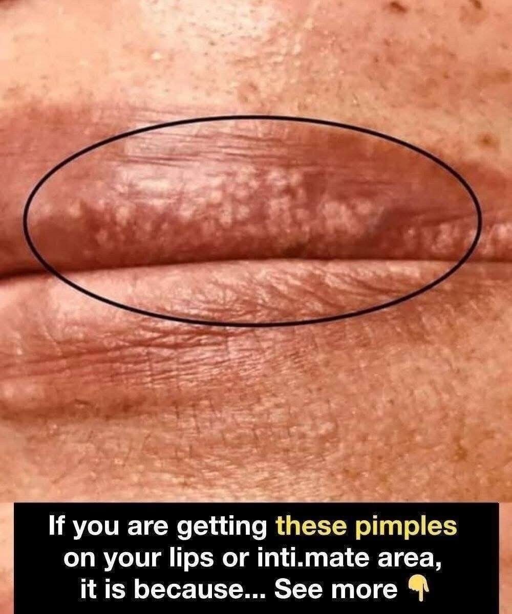 If you are getting these pimples on your lips or int;im:ate area, it is because…