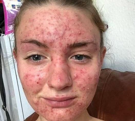 Her body was itching, I thought it was an allergy!