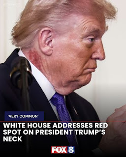 The redness drew widespread attention when news photographers captured close-up images of the president’s neck during a Medal of Honor ceremony. Here was the White House’s response: